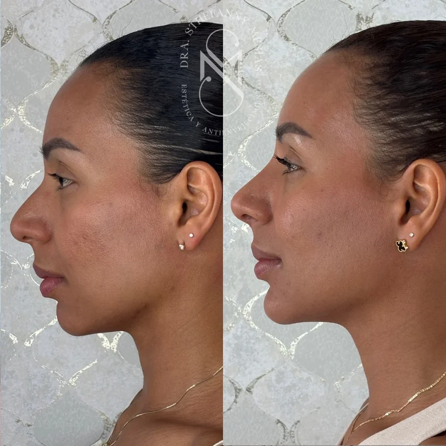 Resultado antes y después de un tratamiento con bioestimuladores de colágeno en Cali